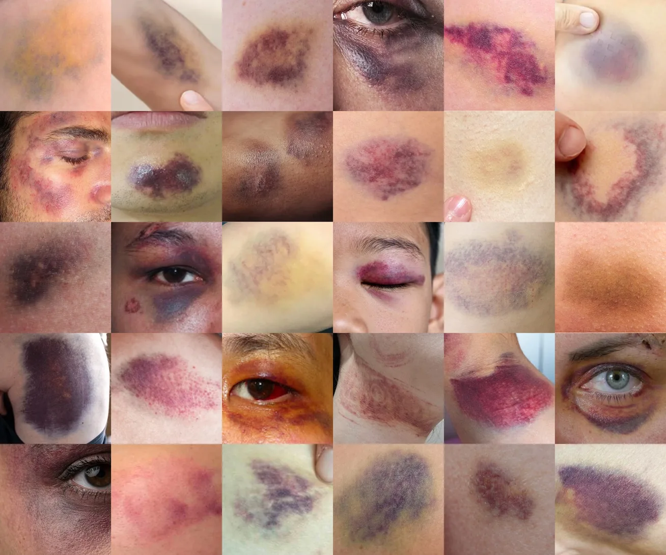 A grid of close-up photos of bruises on different skin tones